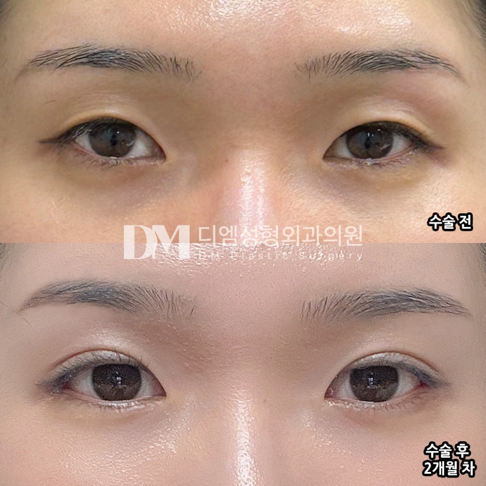 Eyelid Surgery Review. "Recommended if you prefer a natural style!" image 2