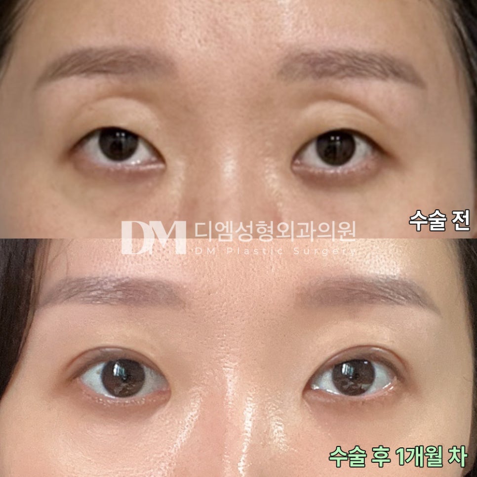 Blepharoplasty Review. “People around me said I did such a good job and that it looks natural” image 2