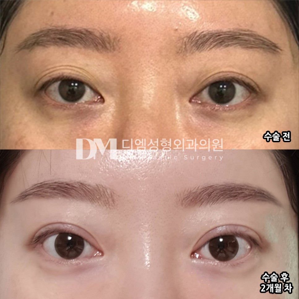 Revision Double-Eyelid Surgery Review: “I’m Satisfied Because It Looks Natural~ It’s Nice That Applying Makeup Is Easier!” image 2