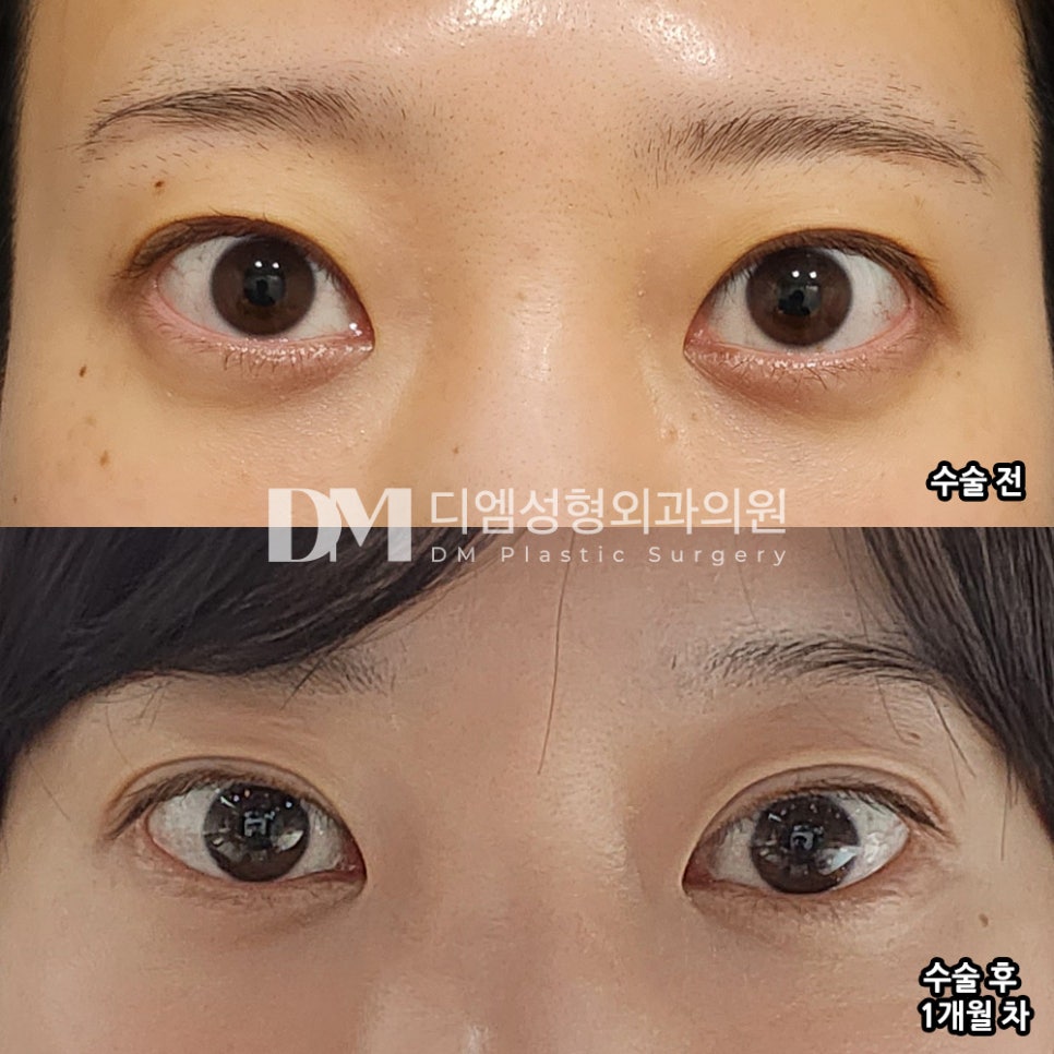 Double Eyelid Revision Surgery Review. "If you’re going to do it anyway, do it sooner and make it yours a day earlier!!" image 2