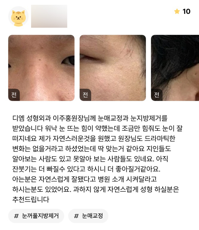 Eye Surgery Review: “Recommended for those who want a natural result without going overboard!” image 1