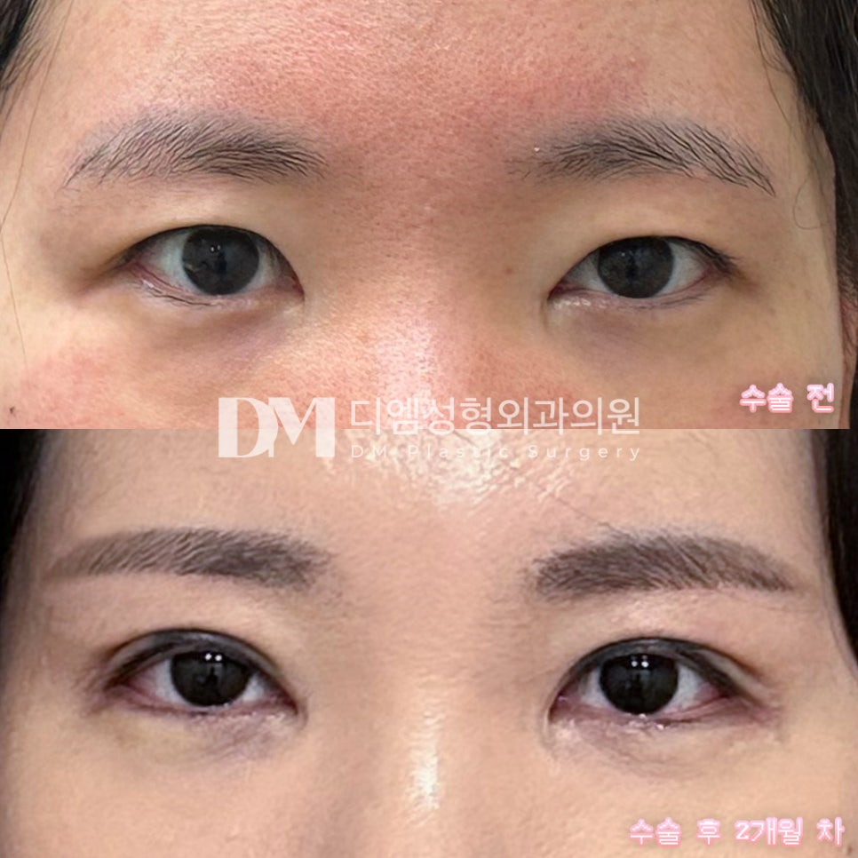 눈성형 후기."인상이 부드러워졌다는 말을 많이 듣고있어요!" 관련 이미지 2