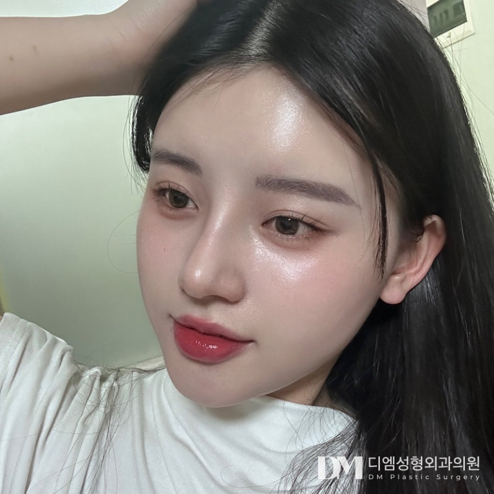 Hump Nose: Correcting It Naturally and Refinedly image 10