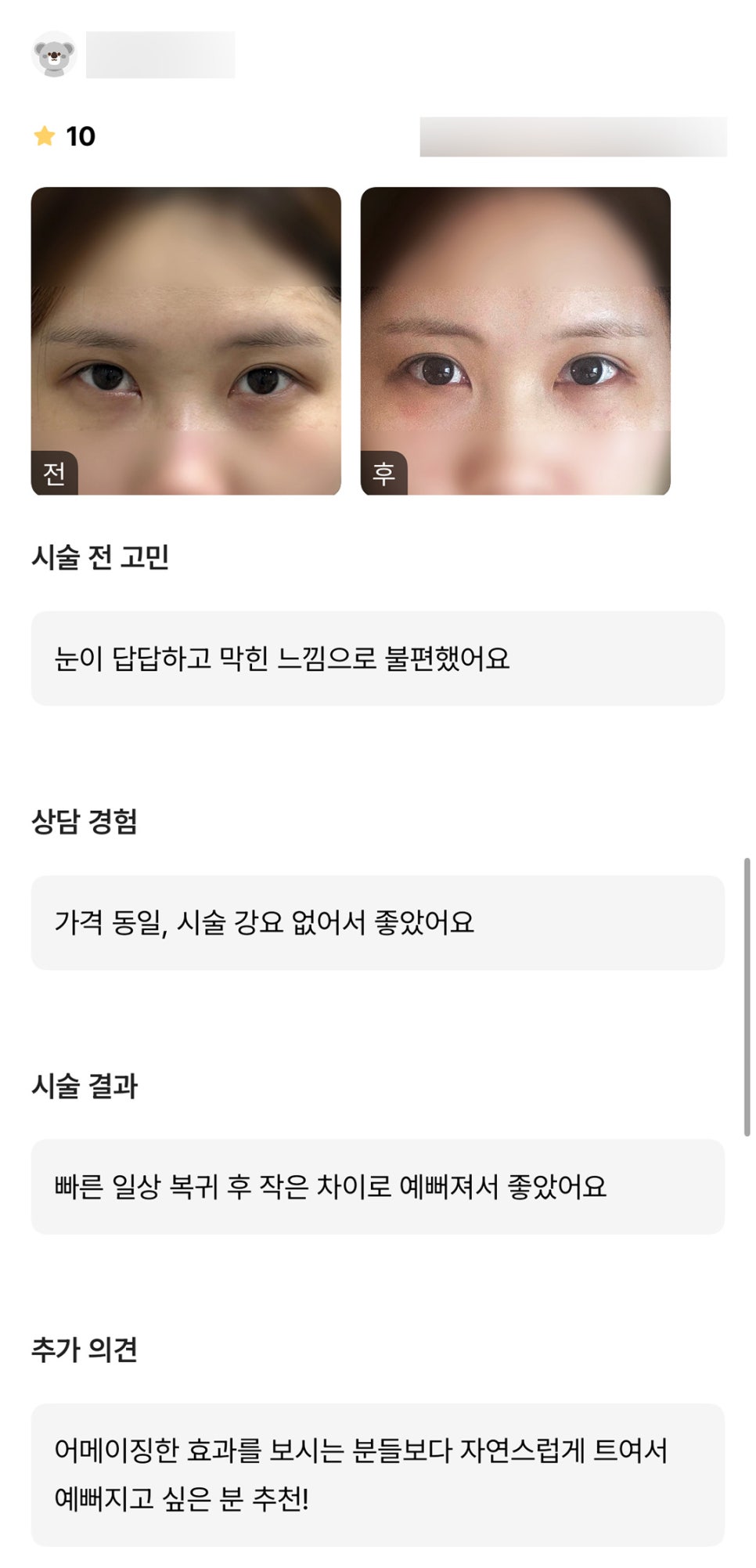 Canthoplasty Review. “Recommended for Those Who Want a Naturally Open, Beautiful Eye Shape!” image 1