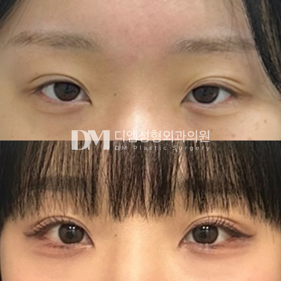 Lateral Canthoplasty Review. “What I’m most satisfied with is that I don’t have to put much effort into makeup for the outer corners of my eyes anymore. I can really feel that my eyes look more open when I do my makeup—it’s truly the best..” image 2