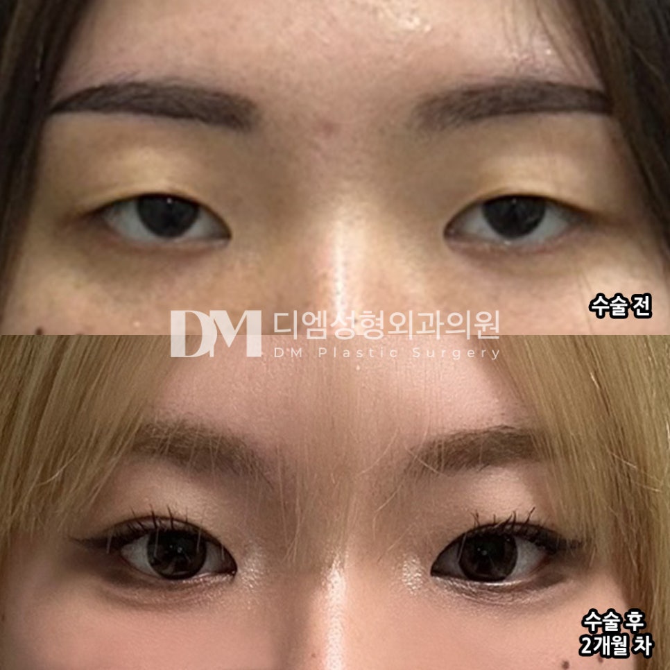 Double Eyelid Surgery Review: “Now They Really Look Like My Own Eyes, and You Can’t Tell at All!” image 2