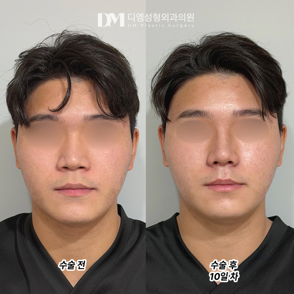 디엠 남자코성형 전후사진, 코 하나로 달라지는 인상! 관련 이미지 2