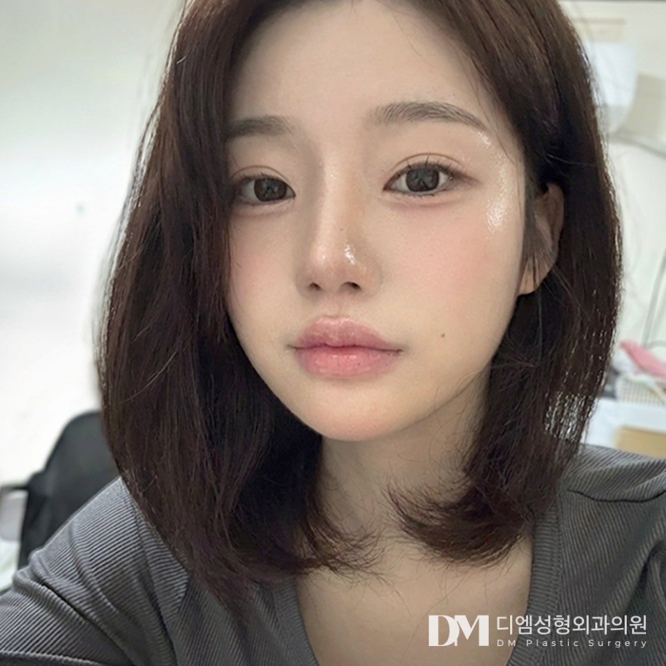 DM Rhinoplasty Before and After Photos: Want to Improve a Flat Side Profile? image 3