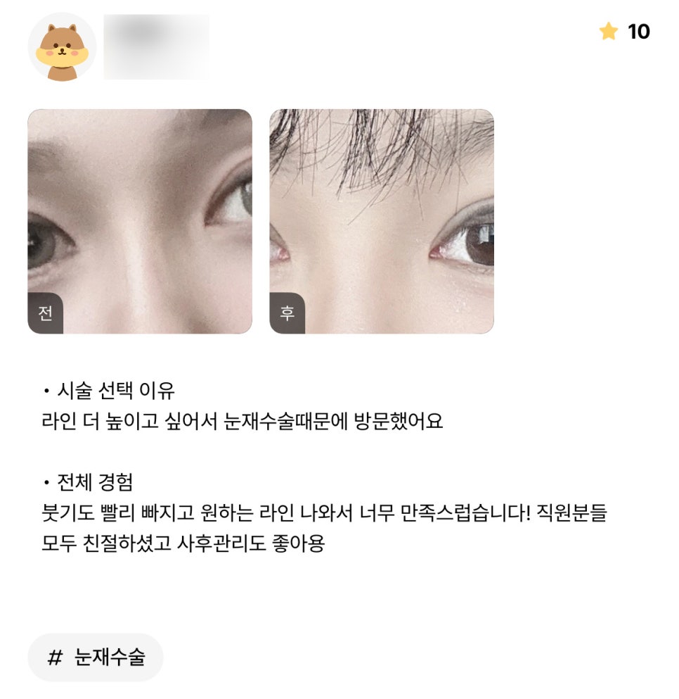 눈재수술 후기."원하는 라인 나와서 너무 만족스럽습니다!" 관련 이미지 1