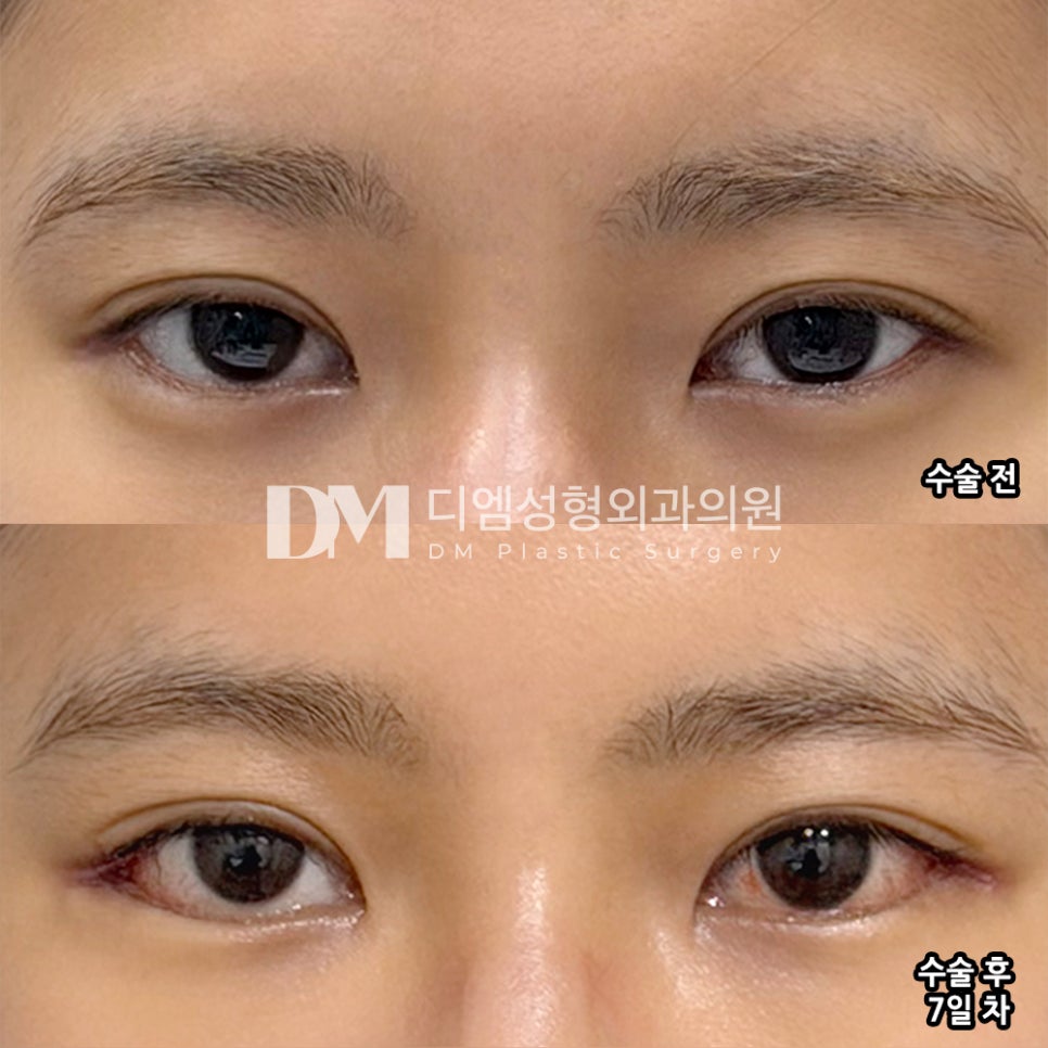 뒤밑트임 전후사진, 답답하고 사나운 눈매 개선 가능할까? 관련 이미지 2