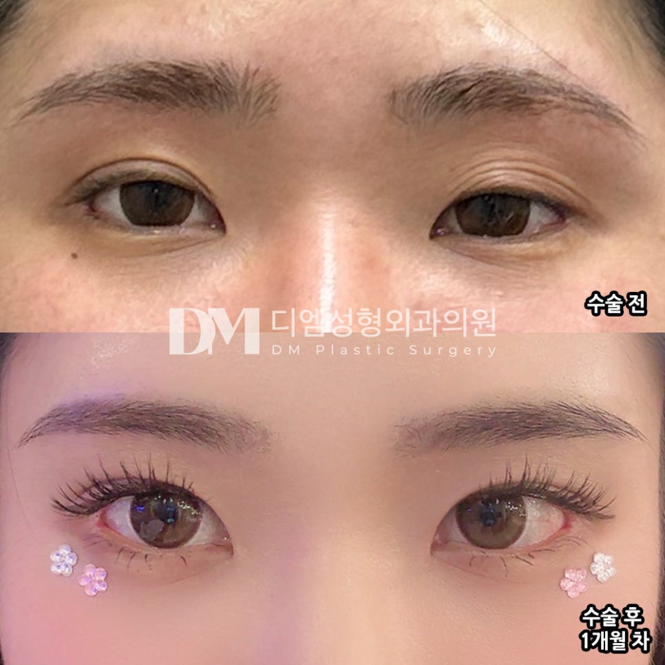 눈재수술 후기."그냥 부은줄 알 정도로 자연스러웠어요!" 관련 이미지 2