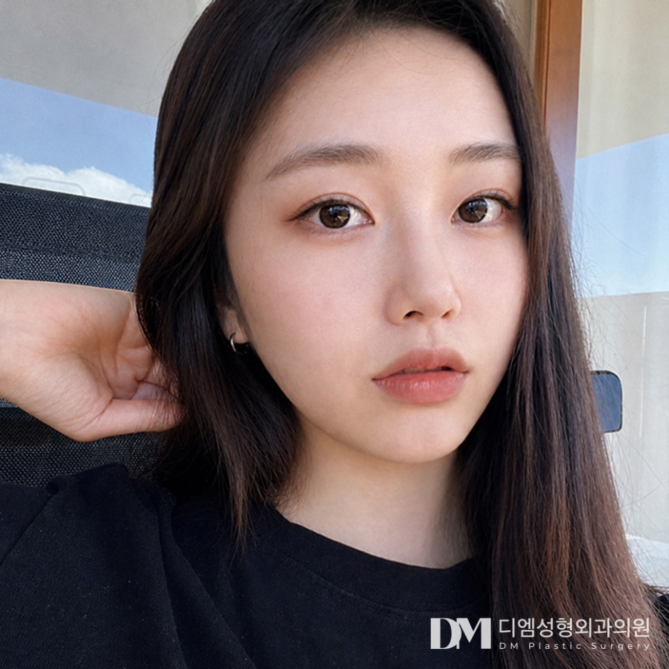 디엠 눈재수술 전후사진, 첫 수술 실패 원인부터 찾아야 합니다! 관련 이미지 1