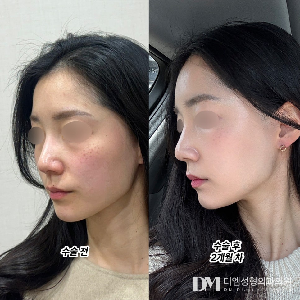 얼굴지방이식 후기."얼굴 살이 없어서 스트레스 받는 부분은 사라져서 만족도 좋습니다! " 관련 이미지 2