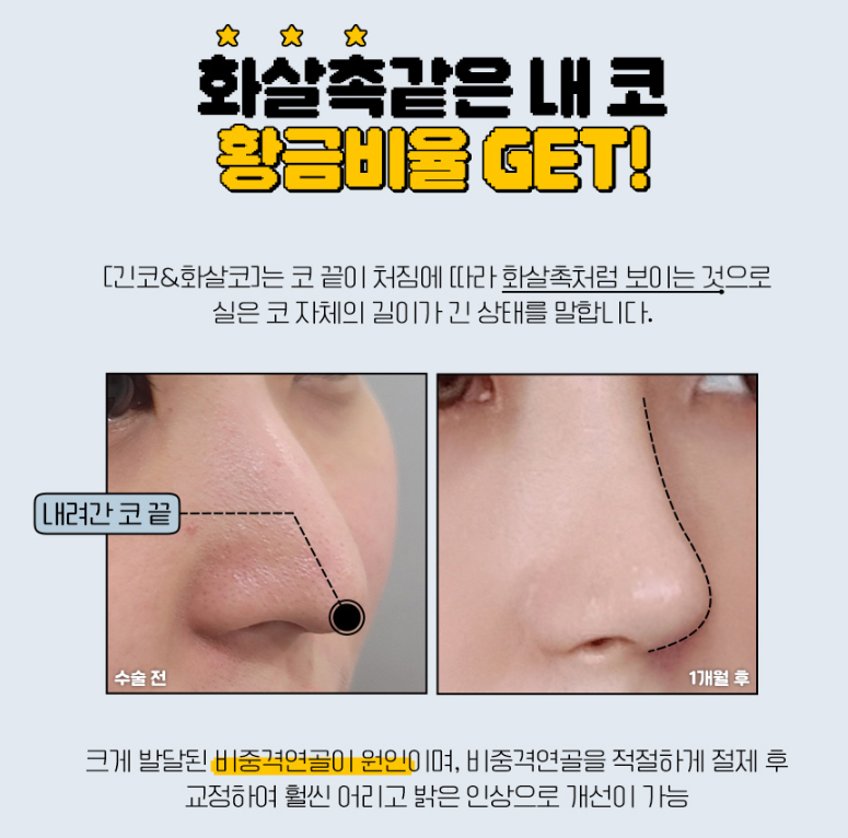 화살코성형, 어느각도에서도 예쁜 코로 변신하기 관련 이미지 2