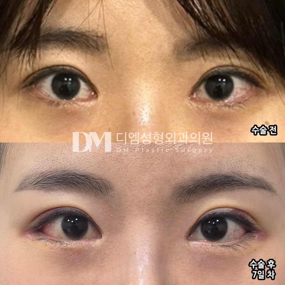 빵트임 후기."올라간 눈매가 컴플렉스였지만 원하던 눈매로 개선되어 좋아요!" 관련 이미지 2