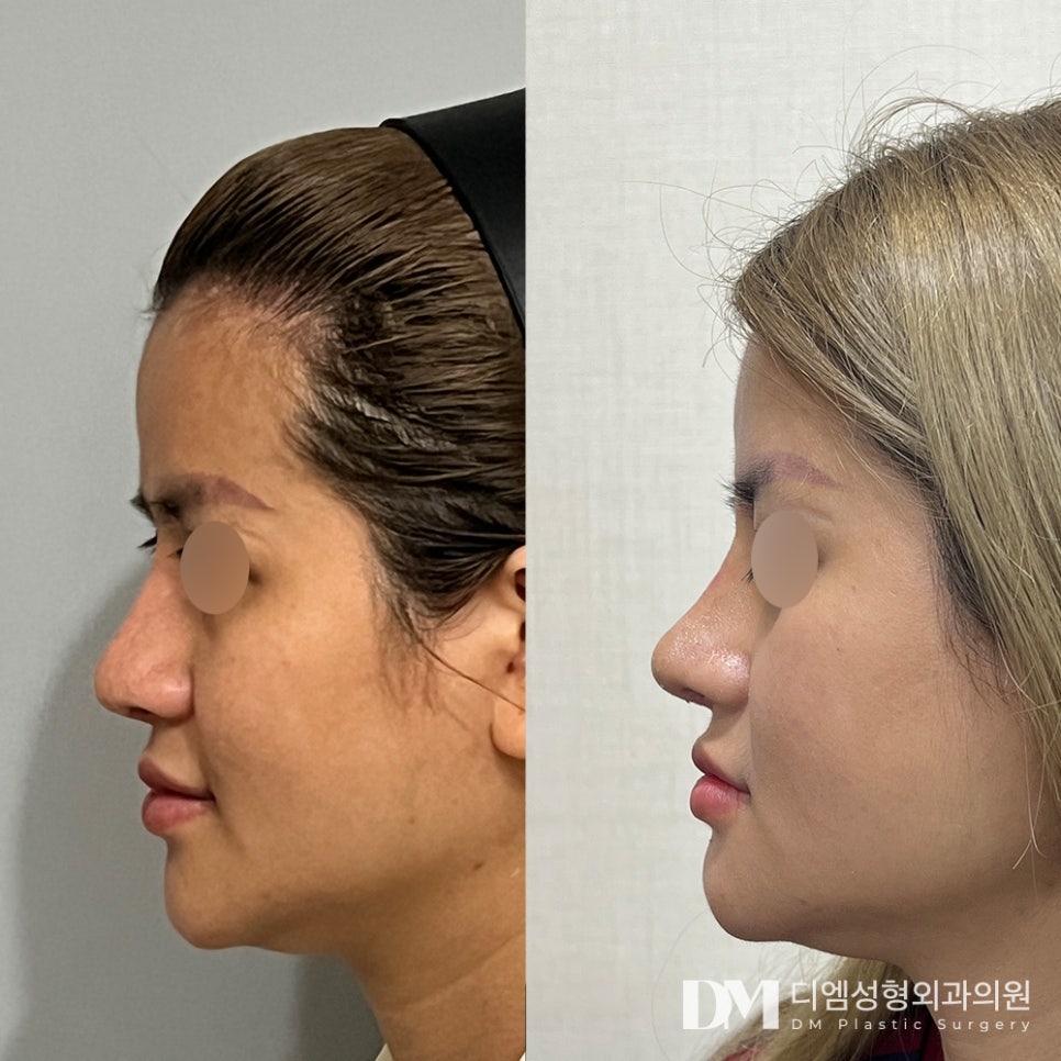Revision Rhinoplasty: Start by Identifying the Problems with the Previous Surgery image 10