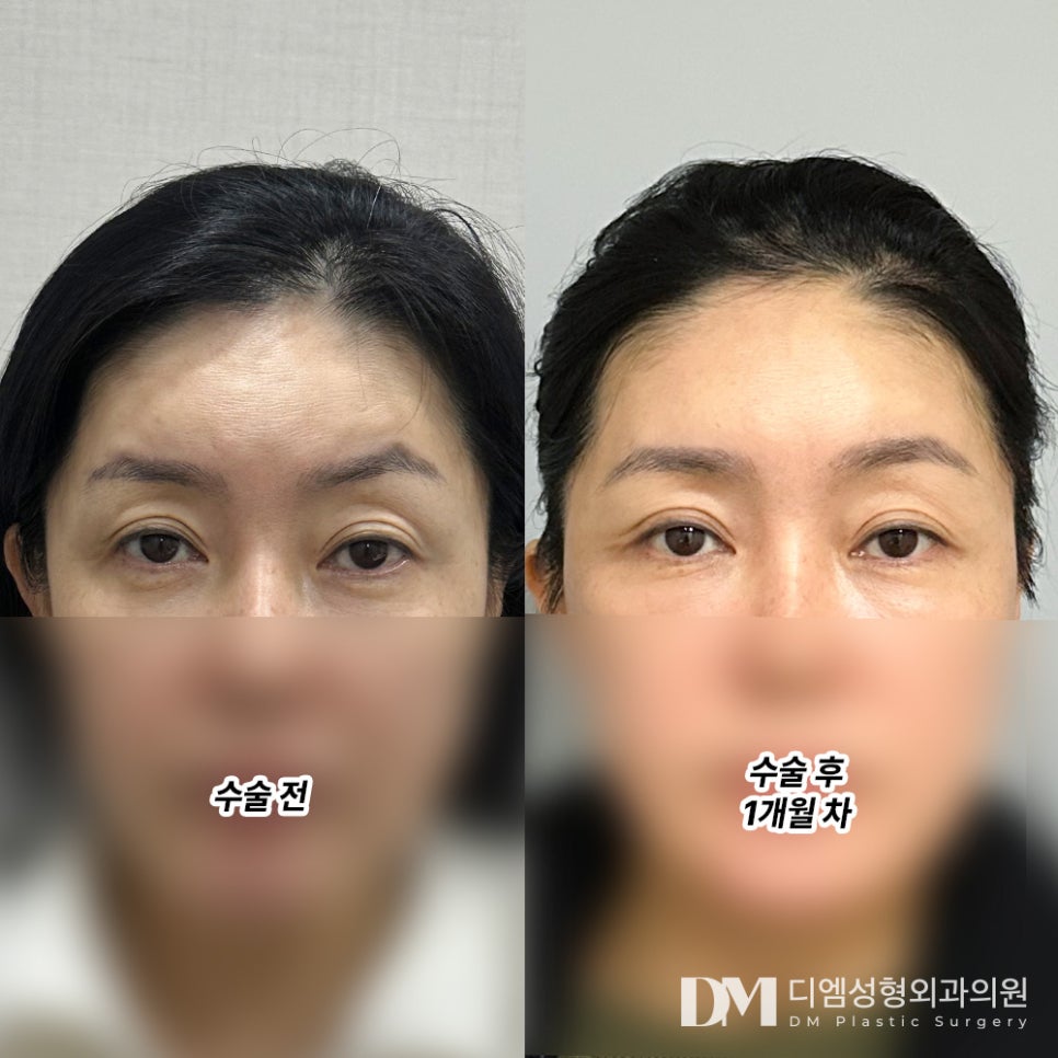 이마거상, 이마 주름과 처진 눈매를 한번에 교정하고 싶다면? 관련 이미지 7
