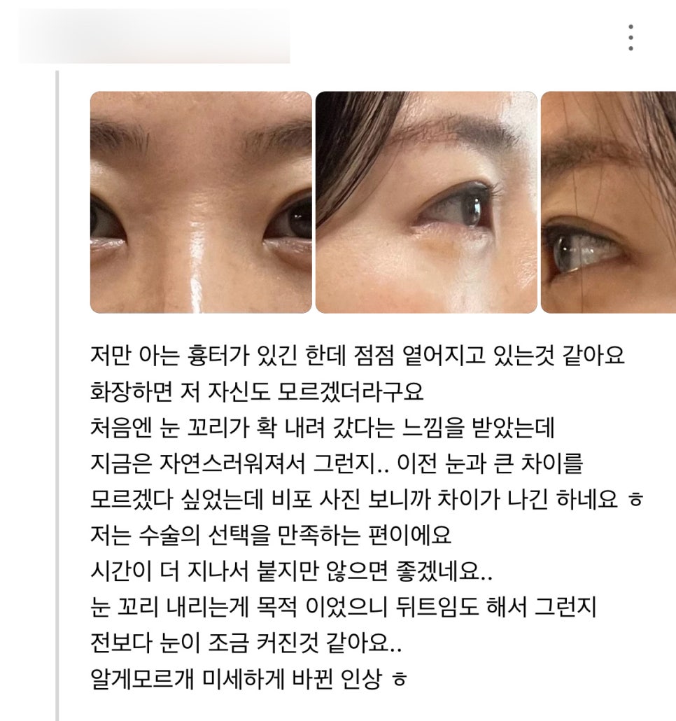 Eye-Opening Surgery Review: “I’m Very Satisfied with the Surgery!” image 1