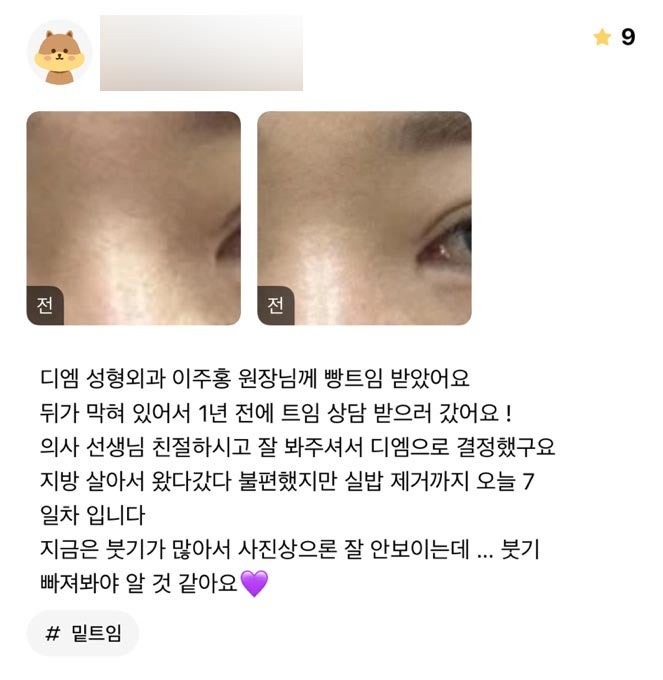 빵트임 후기."의사선생님께서 친절하셔서 디엠으로 결정했어요" 관련 이미지 1