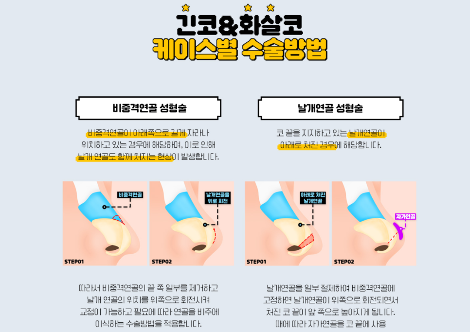 화살코성형, 어느각도에서도 예쁜 코로 변신하기 관련 이미지 5
