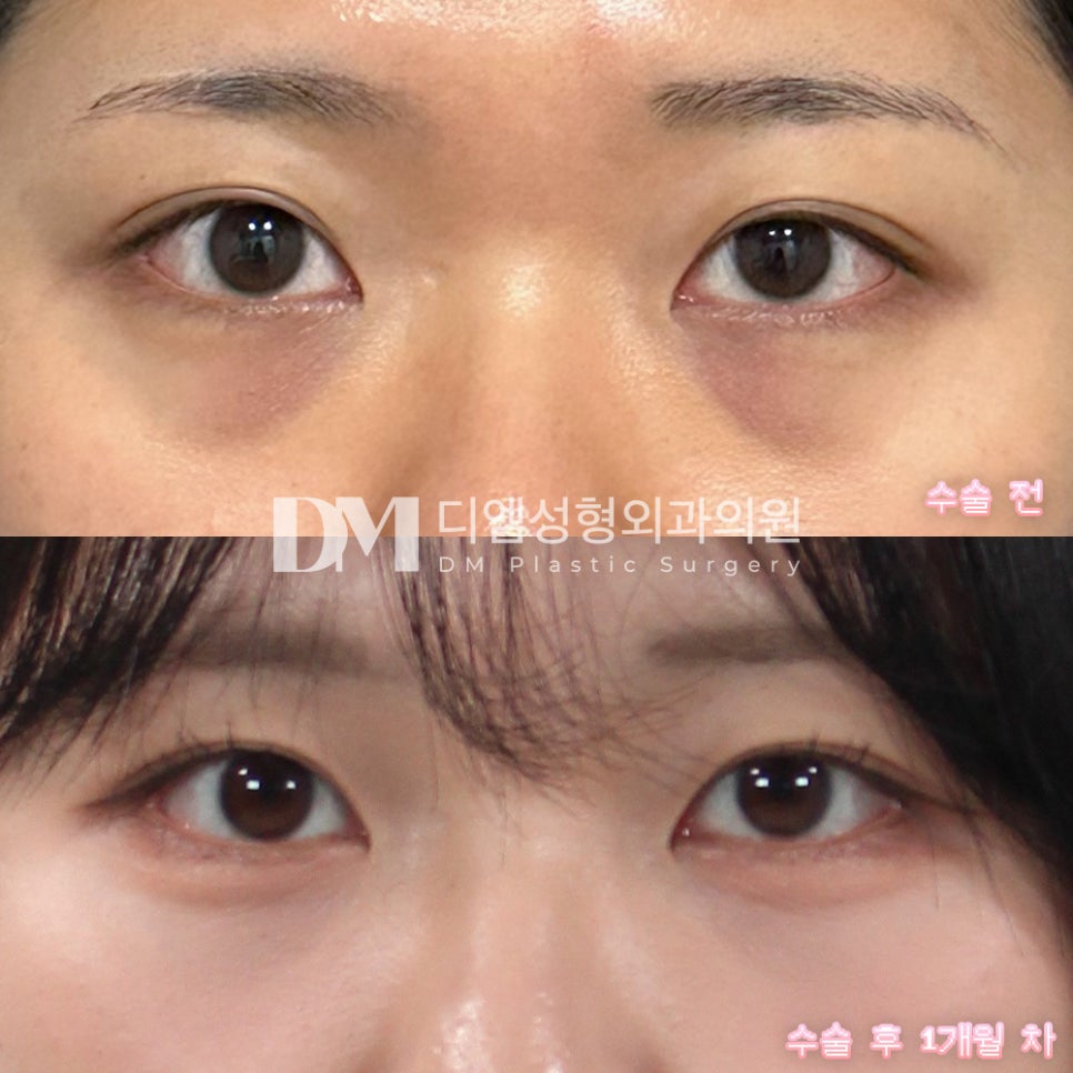 어둡고 울퉁불퉁한 눈밑으로 늘 피곤해보인다는 소리를 듣는다면? 관련 이미지 6