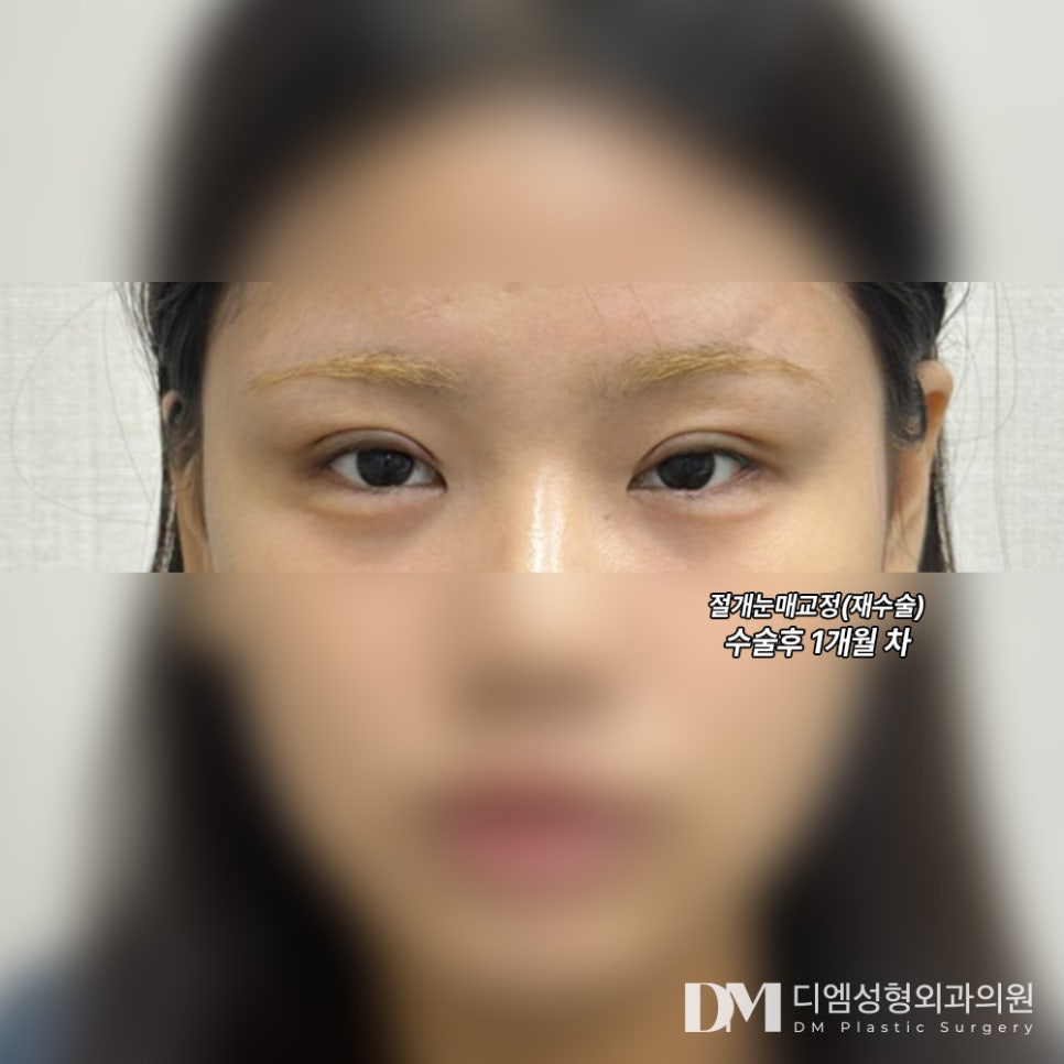 Revision Eyelid Surgery: Identifying the Exact Cause of Failure Is Important! image 9