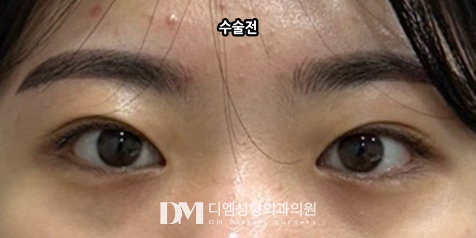 Double-Eyelid Surgery: Looking Your Best for Spring image 8
