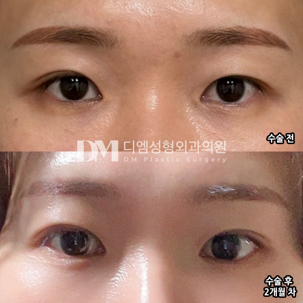Blepharoplasty Revision Review. "Recommended for those who have the same concerns as I do!" image 2