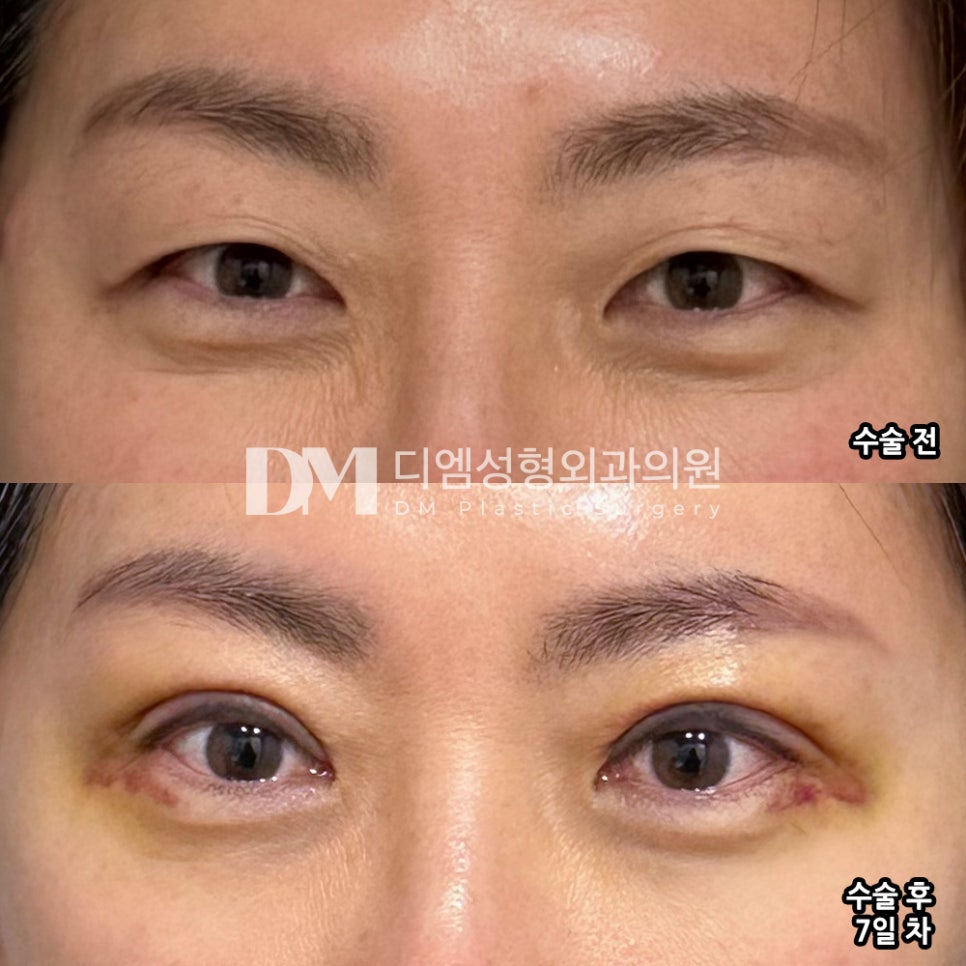 Upper Blepharoplasty: If You’re Concerned About Drooping Eyelids Caused by Aging image 11