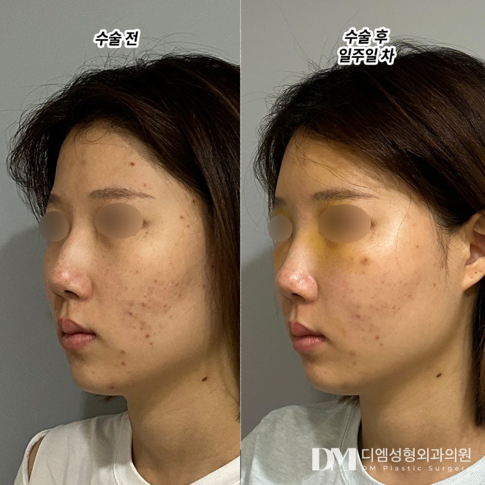 Facial Fat Grafting: If You Want to Look More Youthful and Energetic image 6