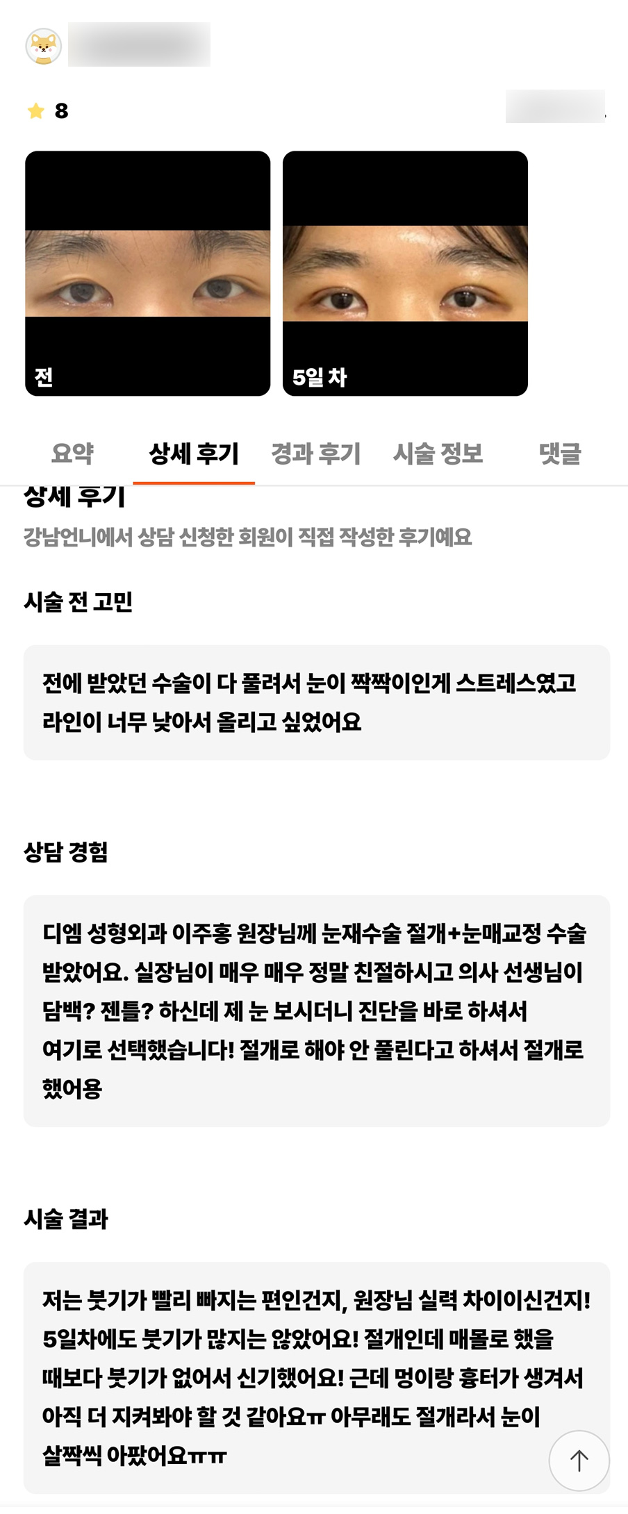 Double Eyelid Revision Surgery Review. "I was surprised that there wasn’t much swelling!" image 1
