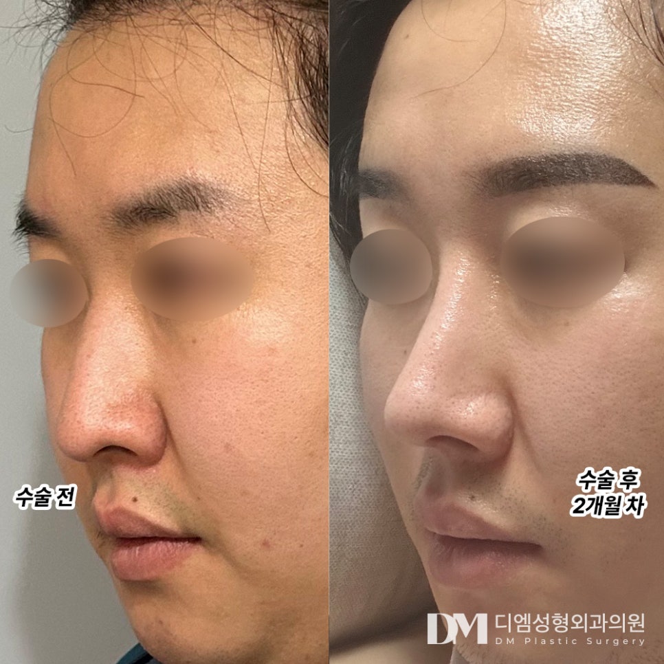 화살코성형 노안 이미지에서 벗어나기 관련 이미지 6