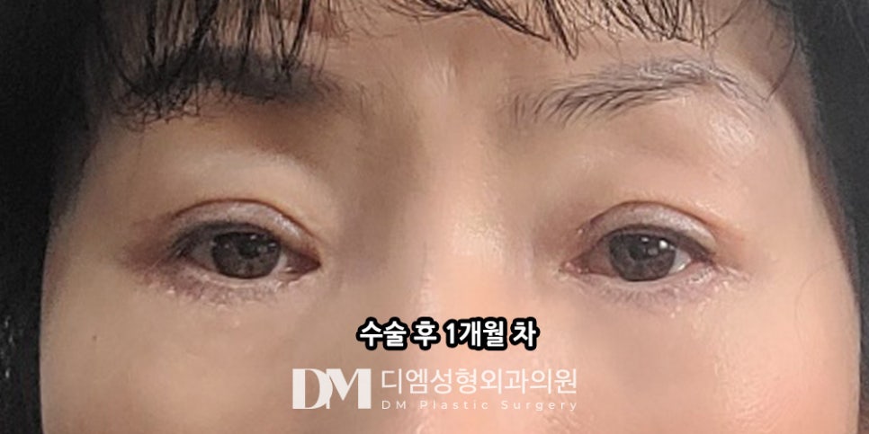 Lower Blepharoplasty: Improve Under-Eye Aging for a More Youthful Look! image 8
