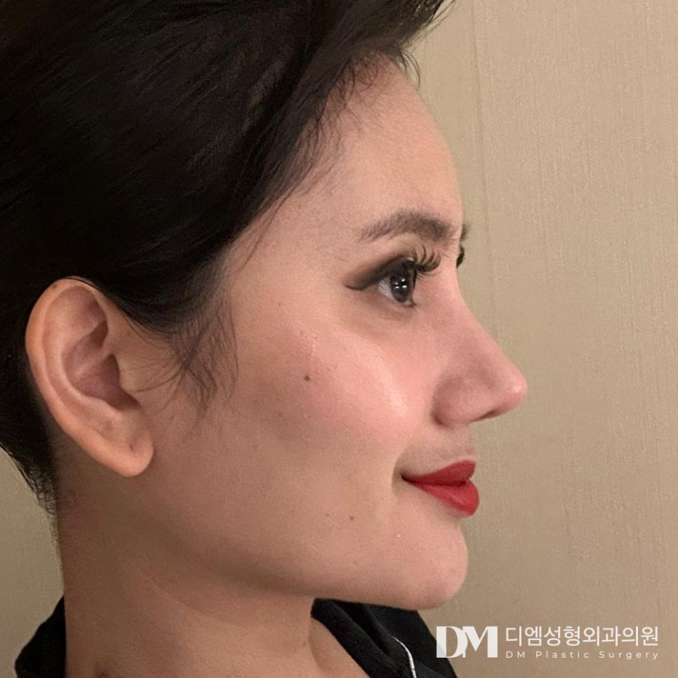 매부리코 성형, 매끈한 콧등라인을 원한다면?! 관련 이미지 10