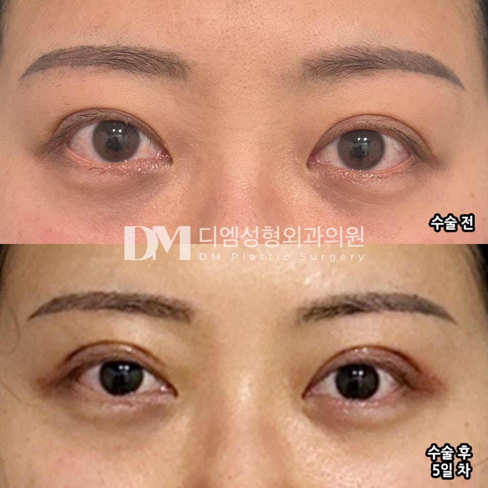 눈재수술 후기."뒷 부분이 트여보여 만족해요 !" 관련 이미지 2
