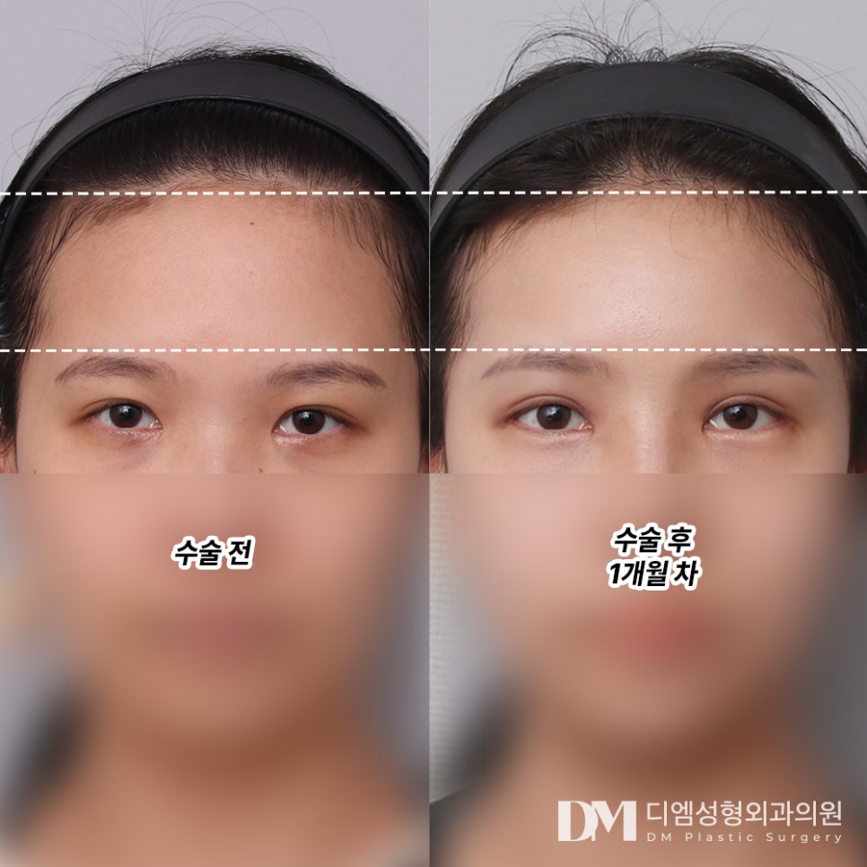 이마거상으로 눈썹 위치부터 이마 주름까지 개선하기 관련 이미지 7