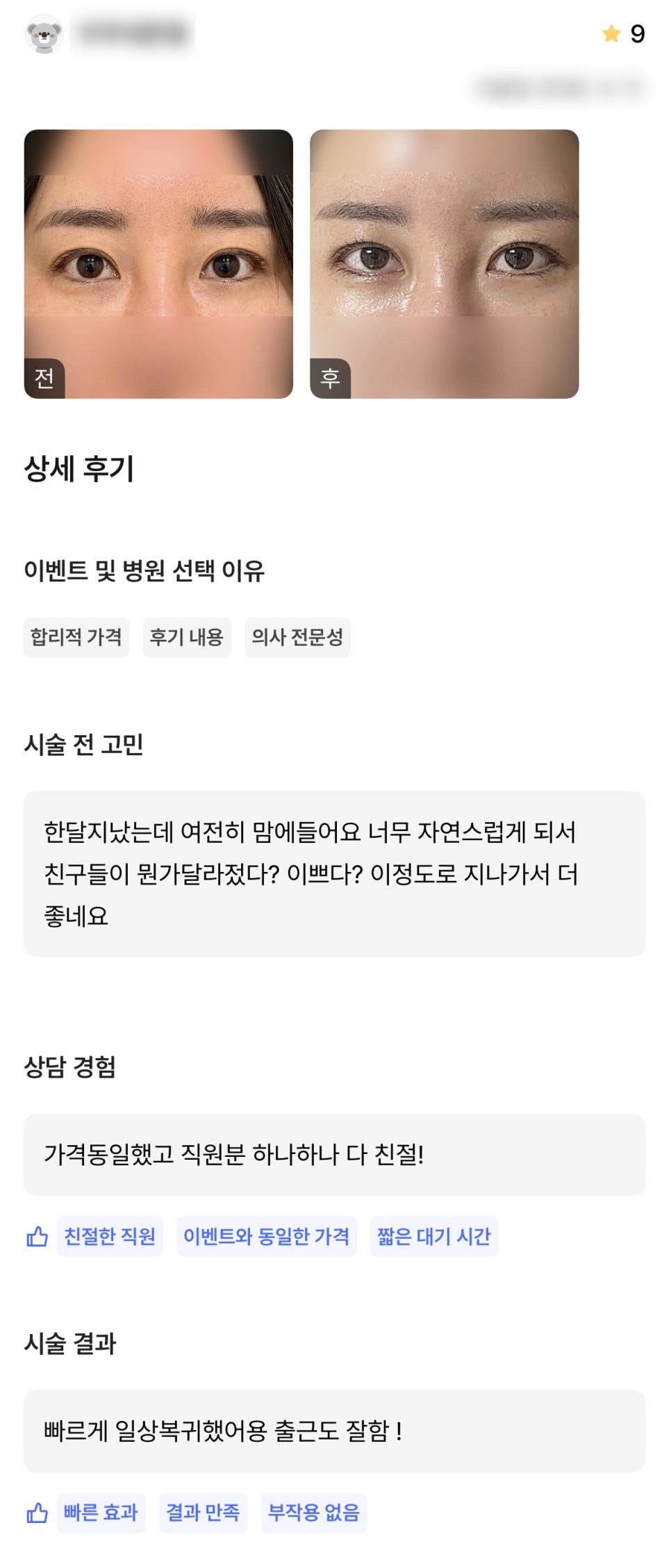 디엠 빵트임 수술후기, “한 달 지났는데 여전히 맘에 들어요!” 관련 이미지 1