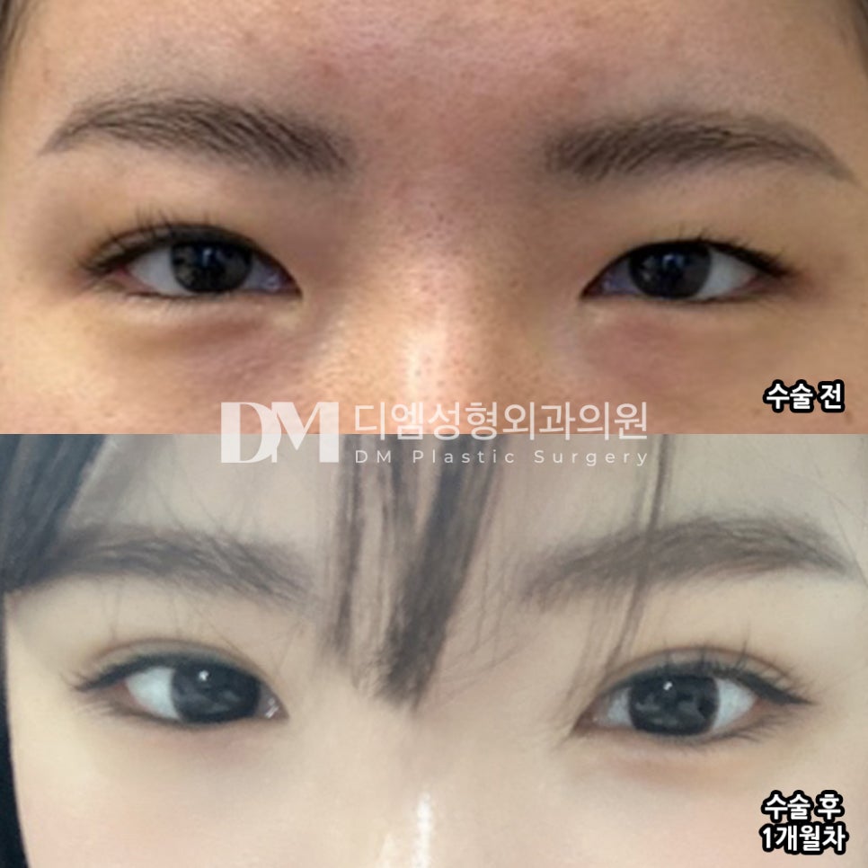 Eyelid Revision Surgery Review: “I’m satisfied that the symmetry has improved to some extent after surgery!” image 2