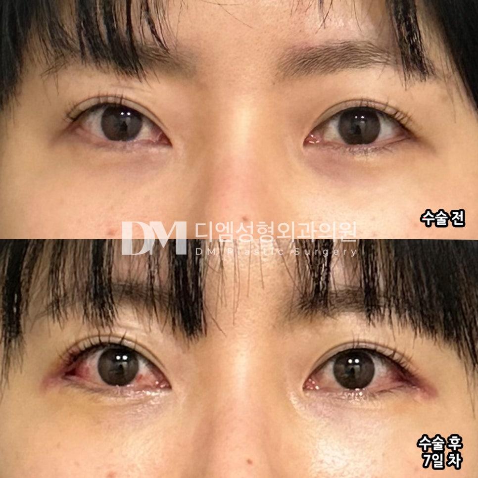 Review of Outer- and Lower-Corner Eye Surgery: “I really like it right now!” image 2