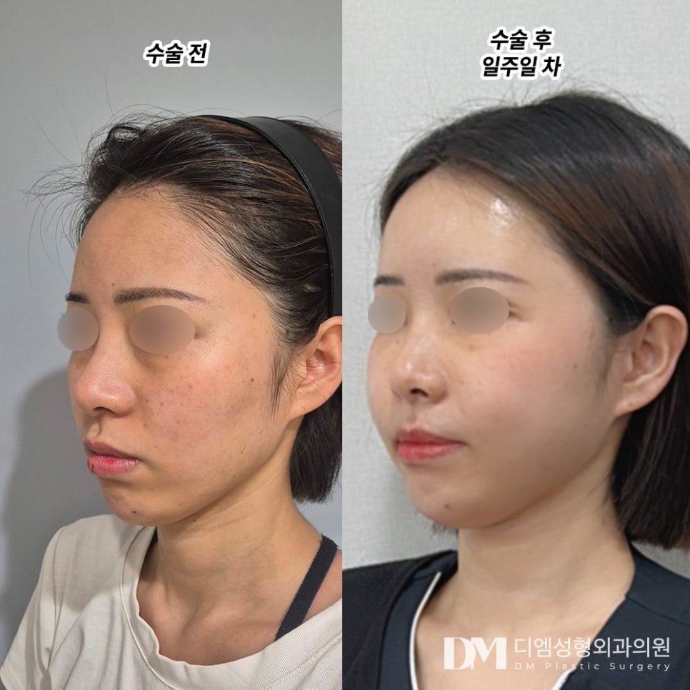 얼굴지방이식 후기."전체적으로 친절한 의료진 덕분에 편안한 경험이었고, 회복도 잘 진행되고 있어 감사한 마음입니다." 관련 이미지 2