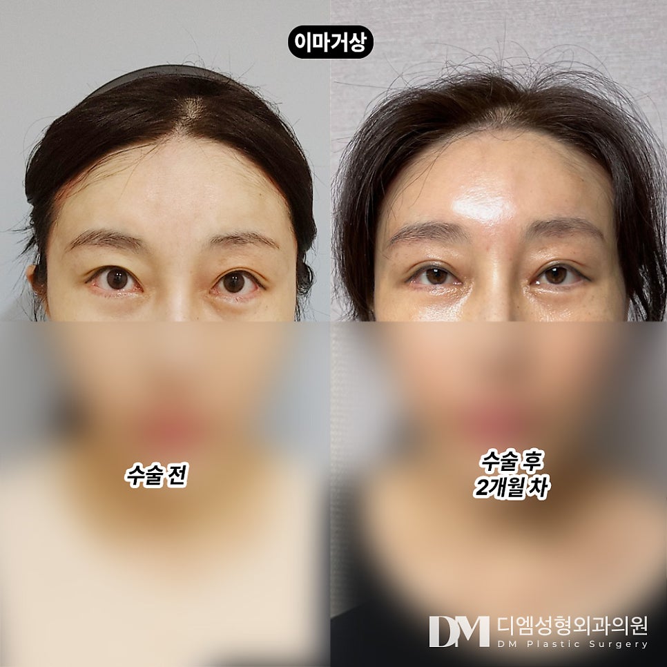 이마거상, 이마주름과 처진 눈모양 동시 개선하기! 관련 이미지 7