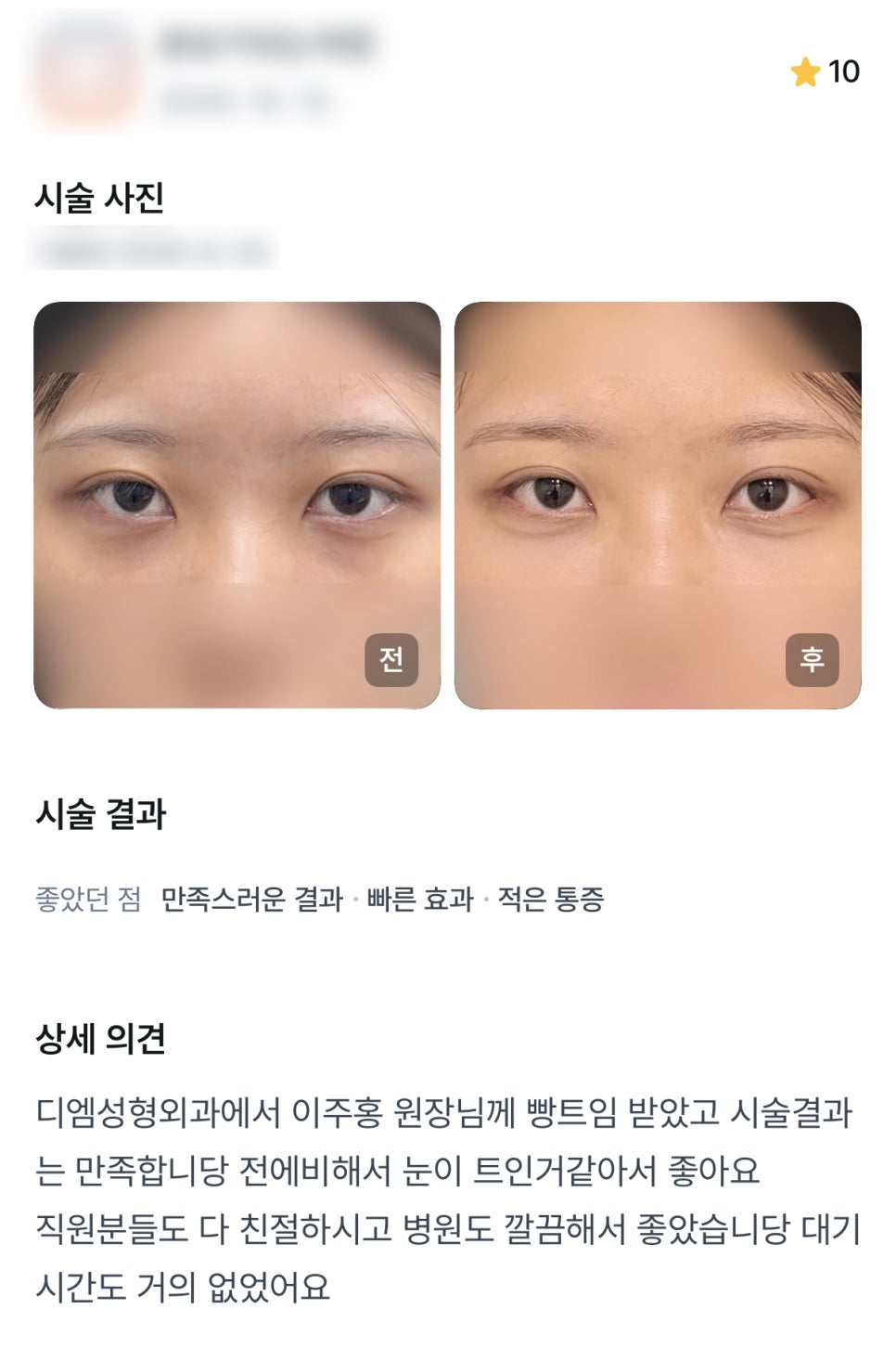 디엠 뒤밑트임/트임성형 후기, “전에 비해서 눈이 트인 거 같아서 좋아요!” 관련 이미지 1