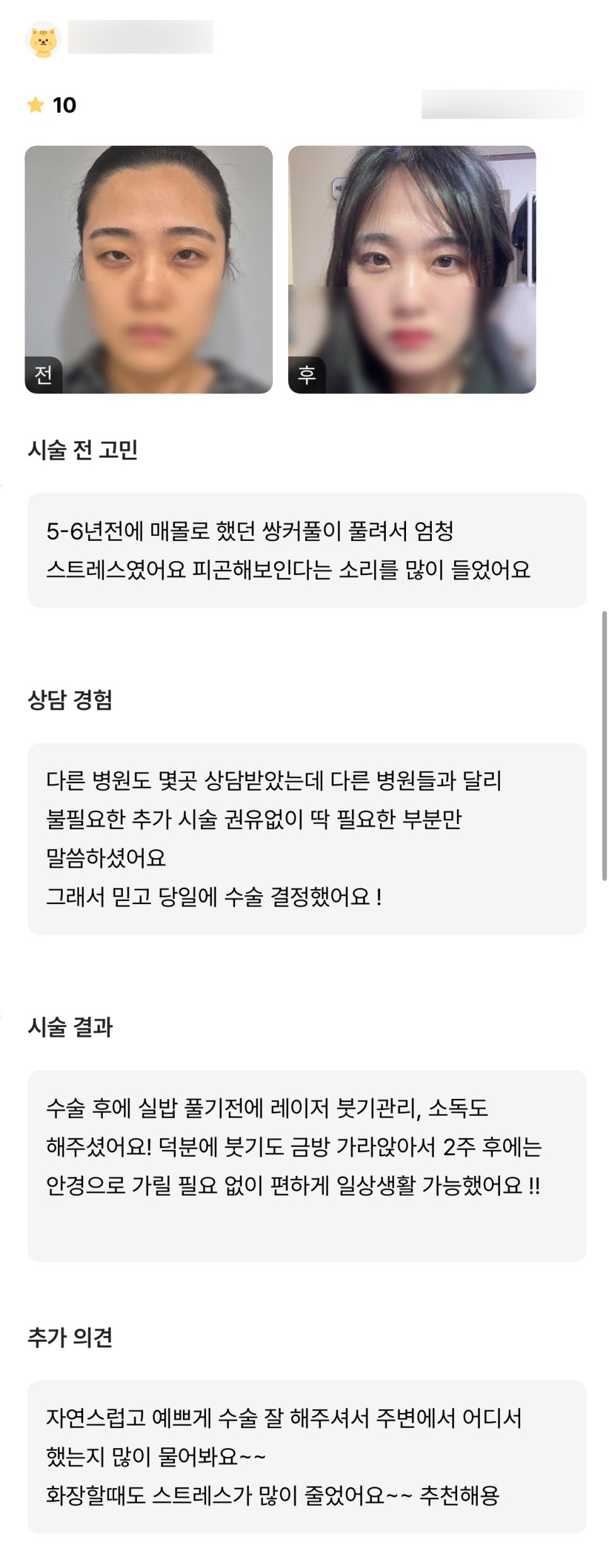 눈재수술 후기."자연스럽게 잘되서 주변에서 어디서 했냐고 물어봐요!" 관련 이미지 1