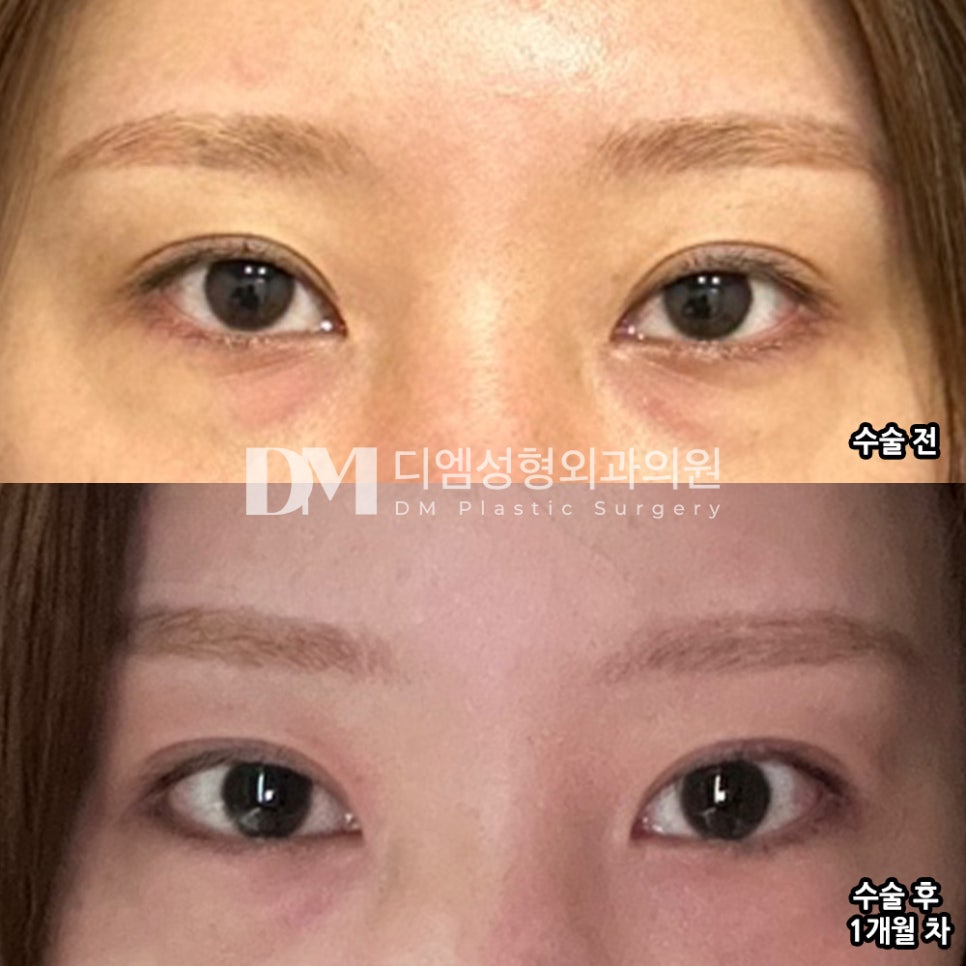 Wide-Opening Canthoplasty Review: “I’m satisfied because my eyes definitely look more open and refreshed, and I feel like they have the look I wanted!” image 2