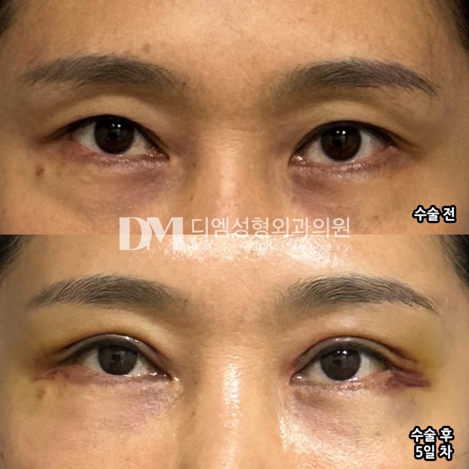Escape Drooping Eyes and Renew Your Eye Area for a More Youthful Look image 11