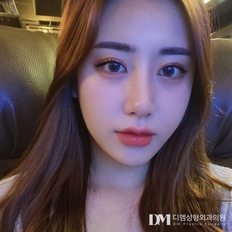 눈재수술, 또 다시 실패는 없어야 하니까! 관련 이미지 14