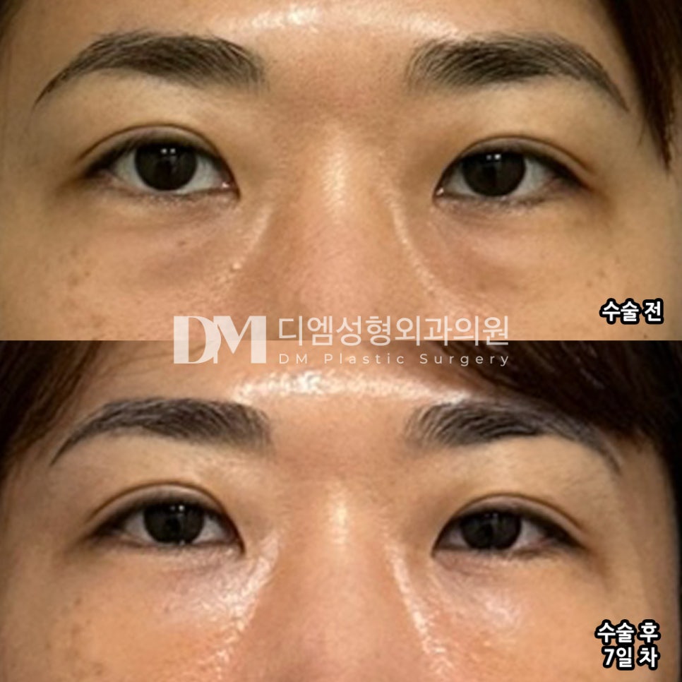 Under-Eye Fat Repositioning Review. "It looks so natural that in a month or two it feels like it will be completely my own eyes!" image 2