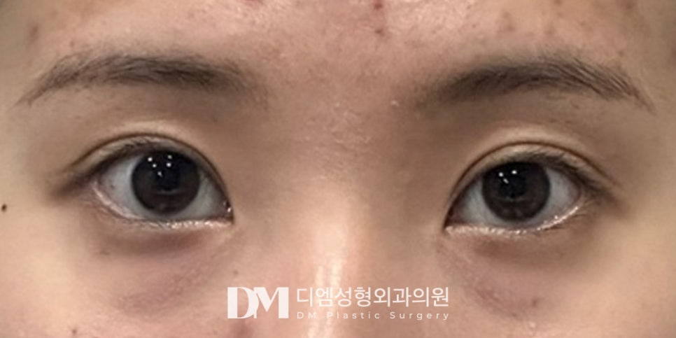 DM’s Expertise-Driven Lower-Lateral Eye Opening image 5