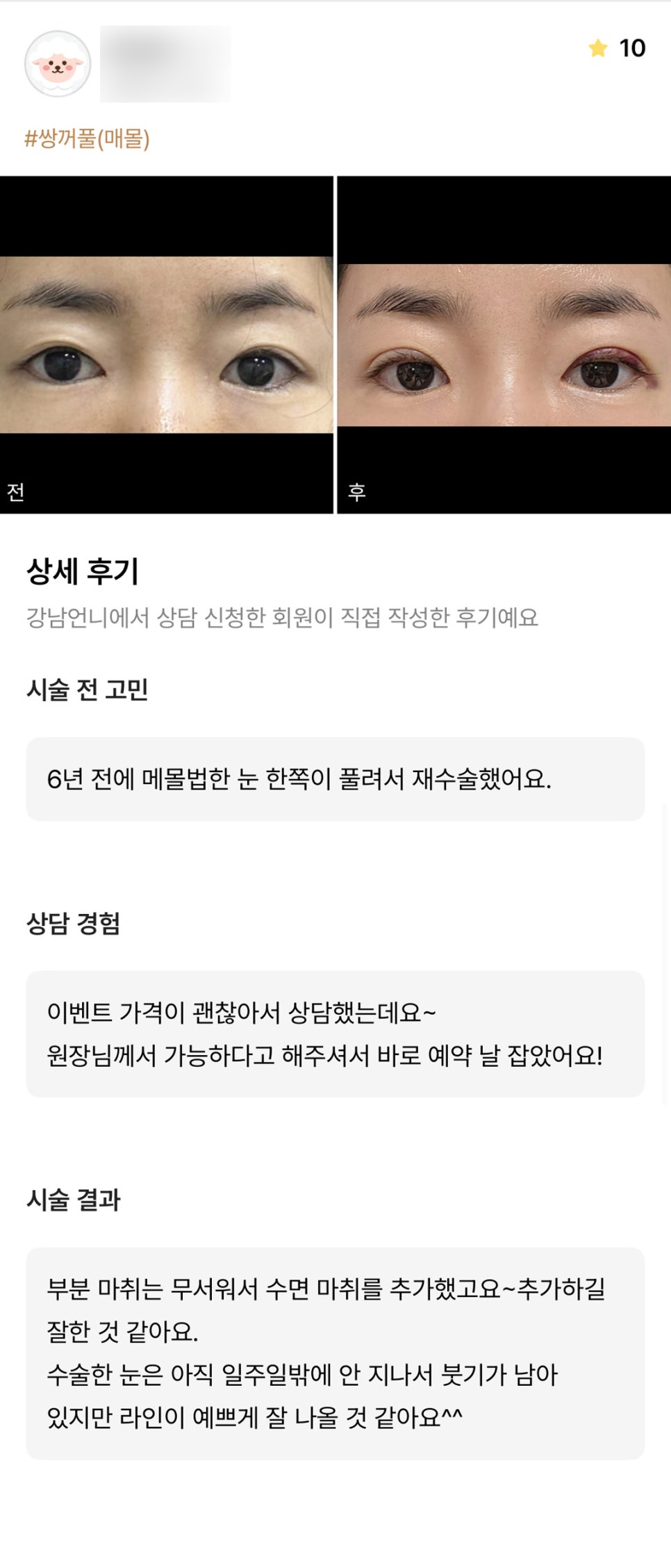 눈재수술 후기."붓기가 남아 있지만 라인이 예쁘게 잘 나올 것 같아요^^" 관련 이미지 1