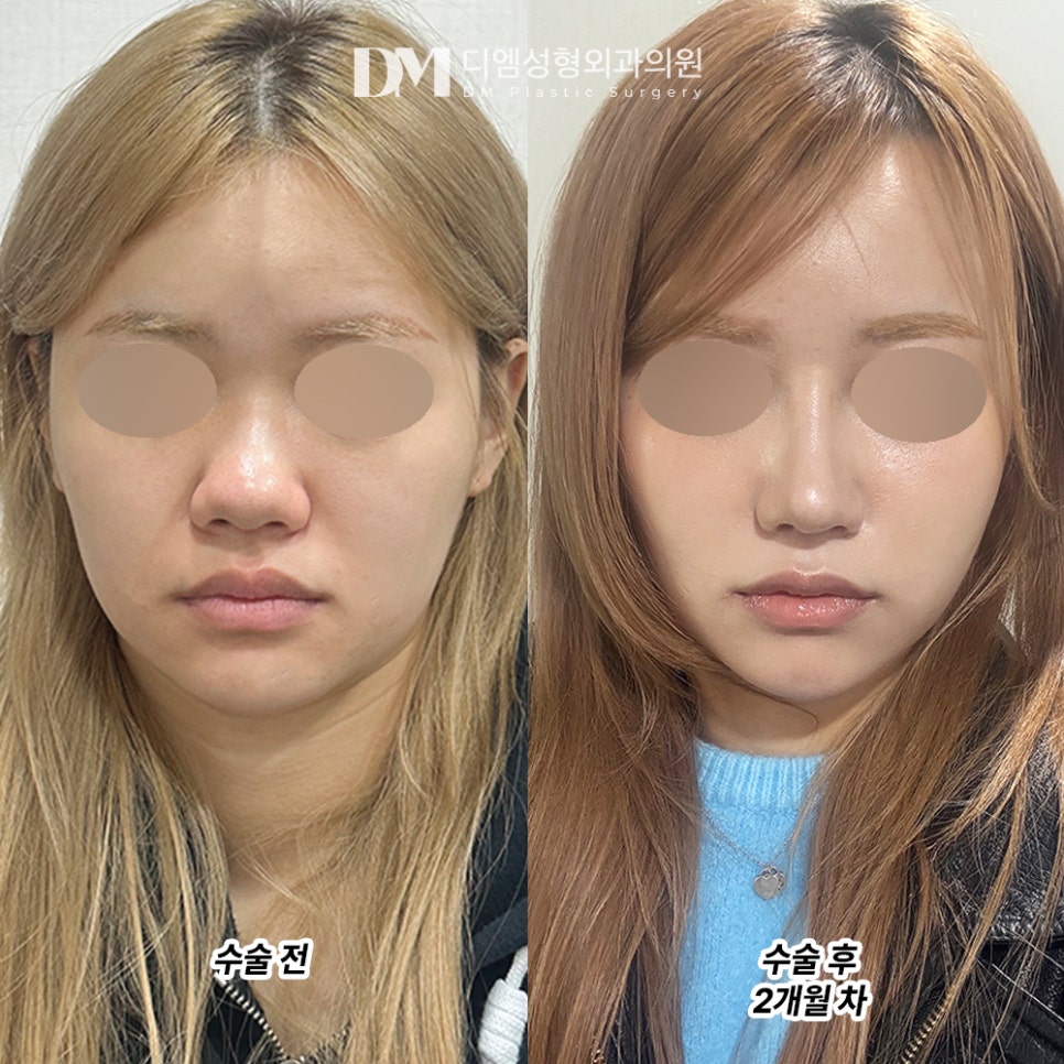 디엠 복코성형 후기사진, 뚱뚱한 코끝 슬림하게 만드는 비결은? 관련 이미지 2